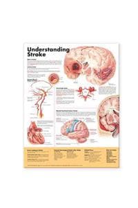 Understanding Stroke...